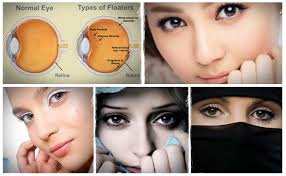 Eye Floaters No More Review